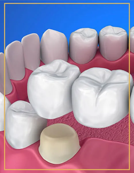 Illustration of a dental bridge fitted over two abutment teeth