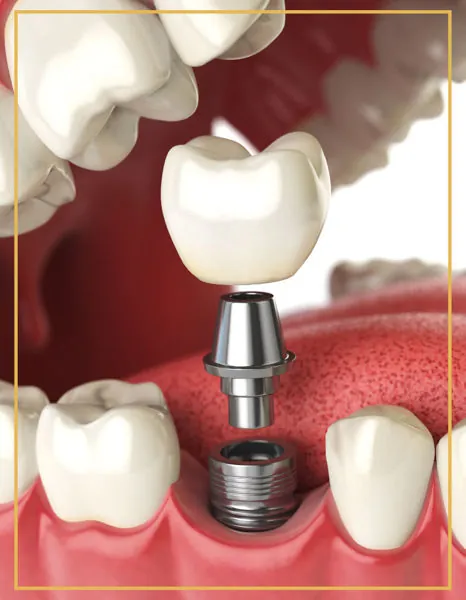 Illustration of a dental implant with abutment and crown placed in the jaw