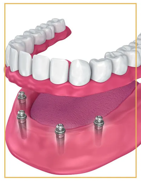 Illustration of an implant-supported complete denture