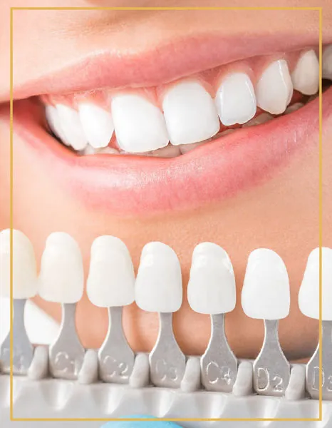 Porcelain laminate veneer shade samples in front of a bright smile