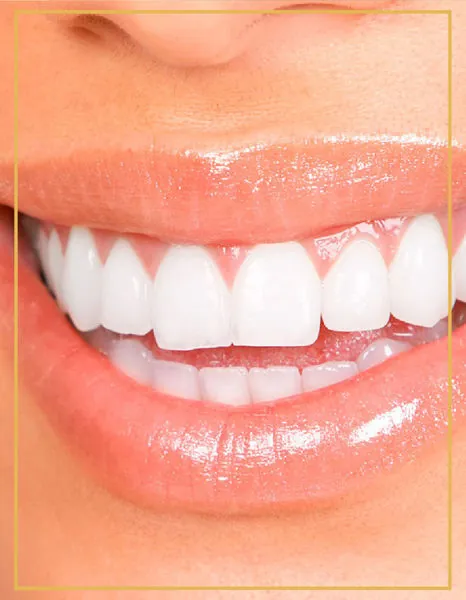 Close-up of a bright white smile after teeth whitening