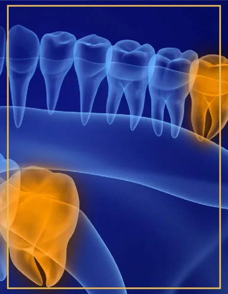 X-ray style illustration of impacted wisdom teeth